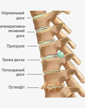 Досвід лікування грижі в спині з гострим болем