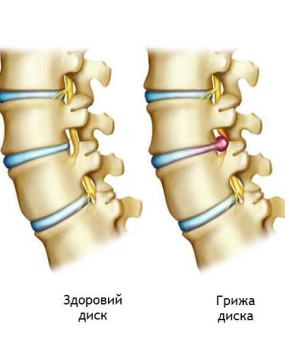 Початкова стадія грижі
