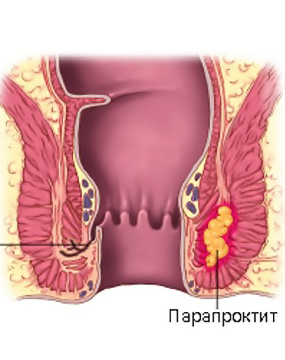 Парапроктит