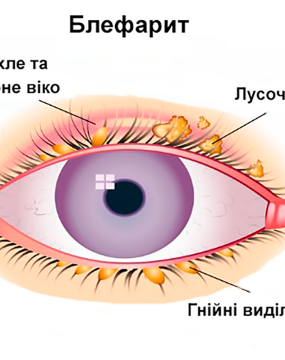 Блефарит